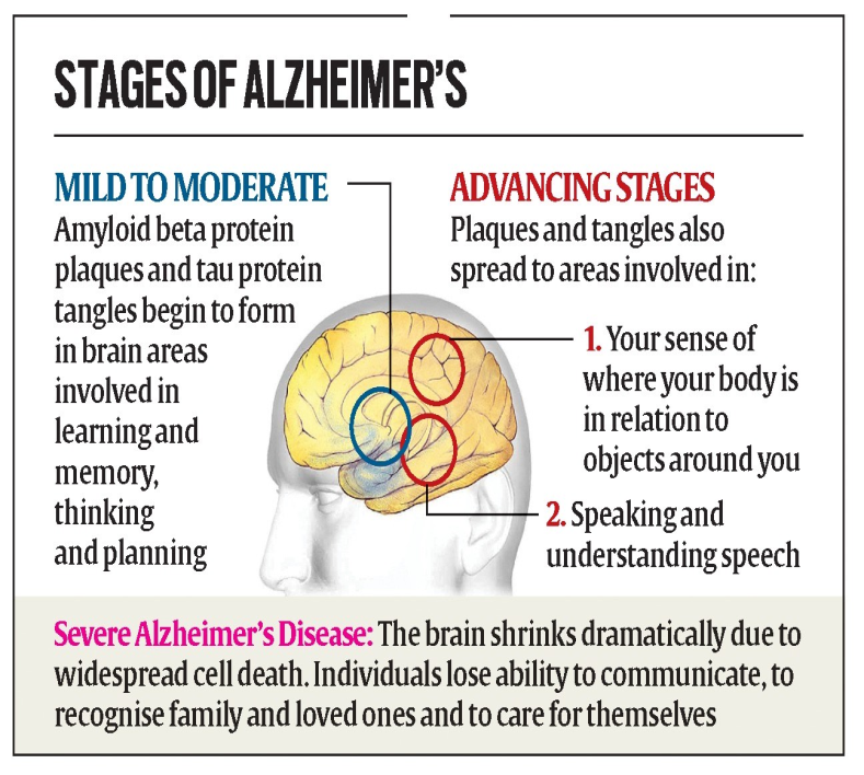 Semaglutide May Reduce Alzheimer's Risk in Diabetics