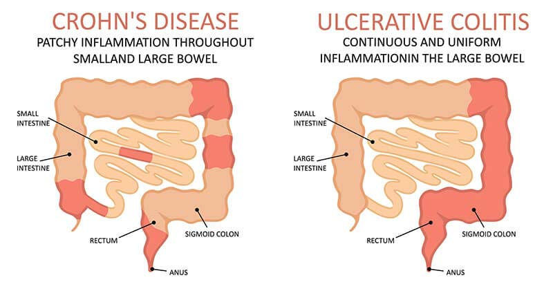 Crohn’s Disease: Chronic Digestive Condition and Management