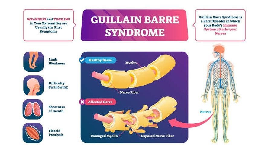 Guillain-Barré Syndrome Outbreak in Pune: 73 Cases