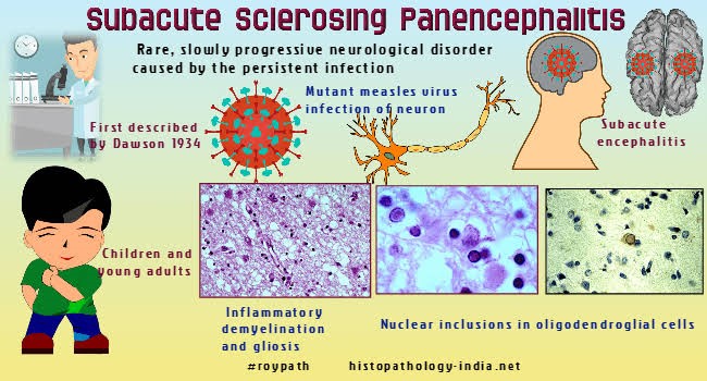 SUBACUTE SCLEROSING PANENCEPHALITIS (SSPE): A RARE AND FATAL BRAIN DISORDER