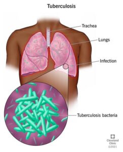 TB Drugs Off-Patent: Govt Channels Only Access