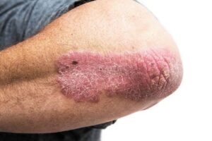Govt Warns Heart Drugs May Trigger Psoriasis