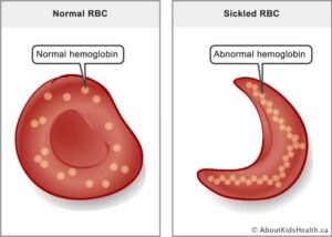 Comprehensive Strategies to Contain Sickle Cell Disease