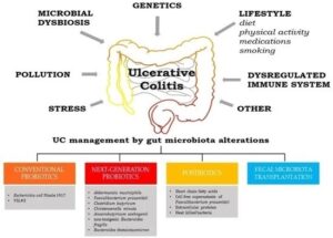 Microbial Trigger in Early Ulcerative Colitis