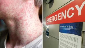 Sydney Measles Alert: Cases Surge